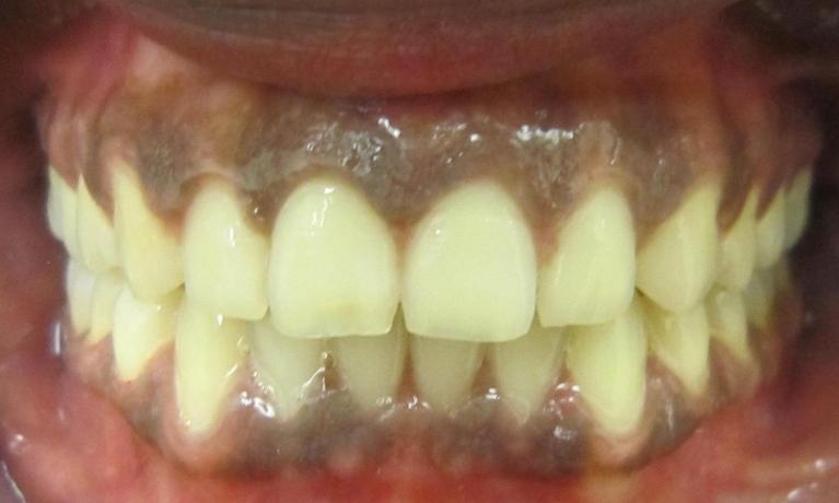 After Invisalign