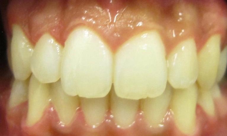 After Another Invisalign