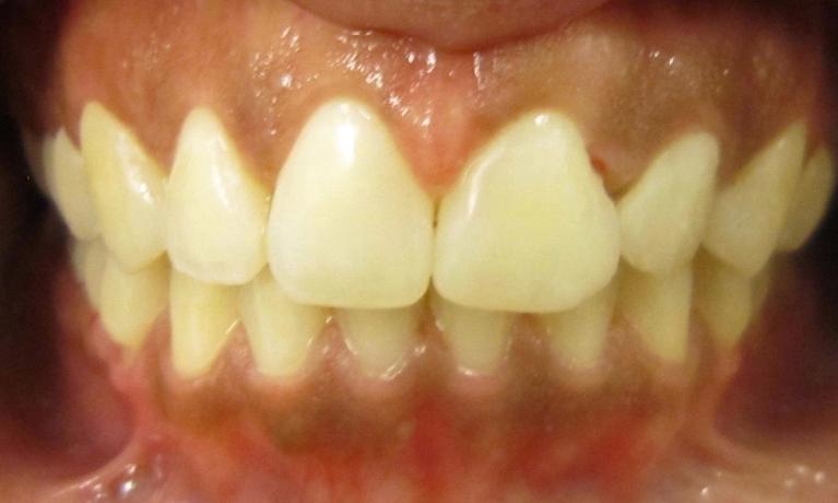 Picture after Invisalign