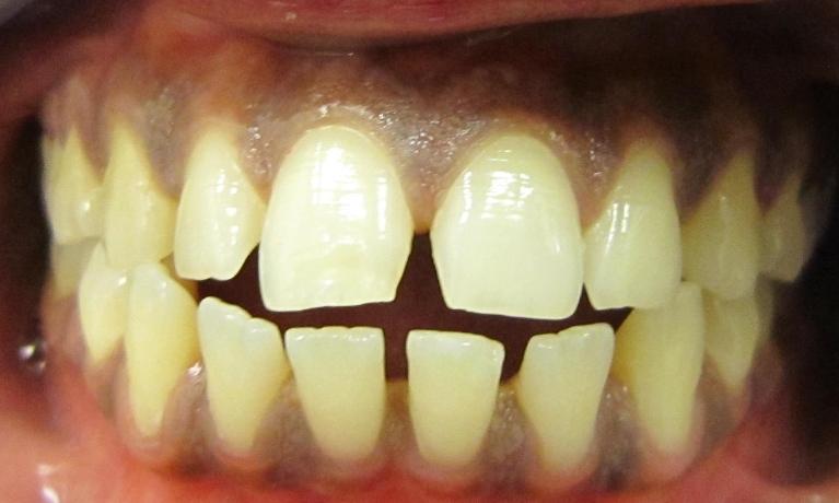 Before Invisalign