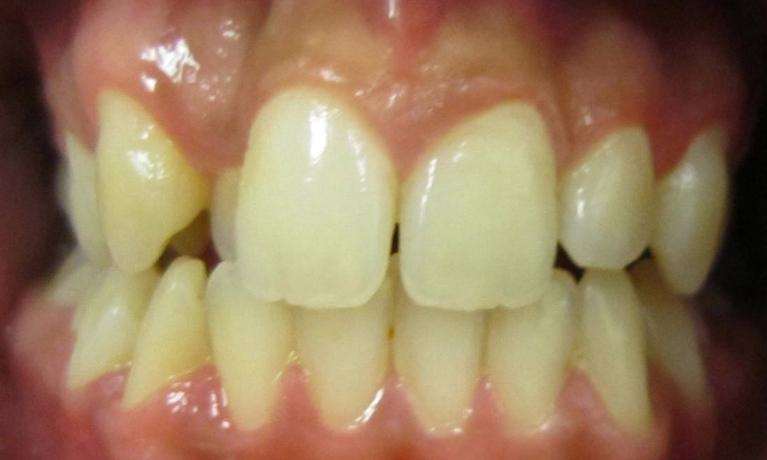 Before Another Invisalign