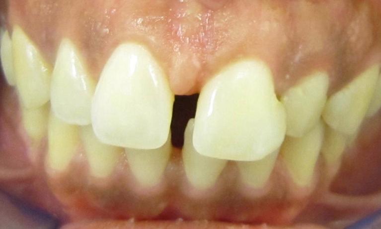 Picture before Invisalign