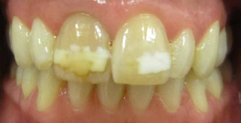 Teeth before Cosmetics Dentistry