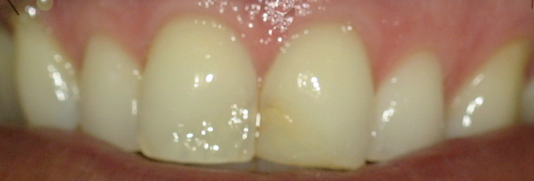 Before Cosmetics Dentistry