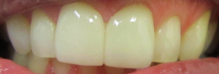 After Cosmetics Dentistry