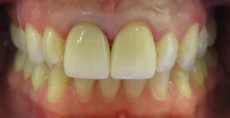 Teeth after Cosmetics Dentistry